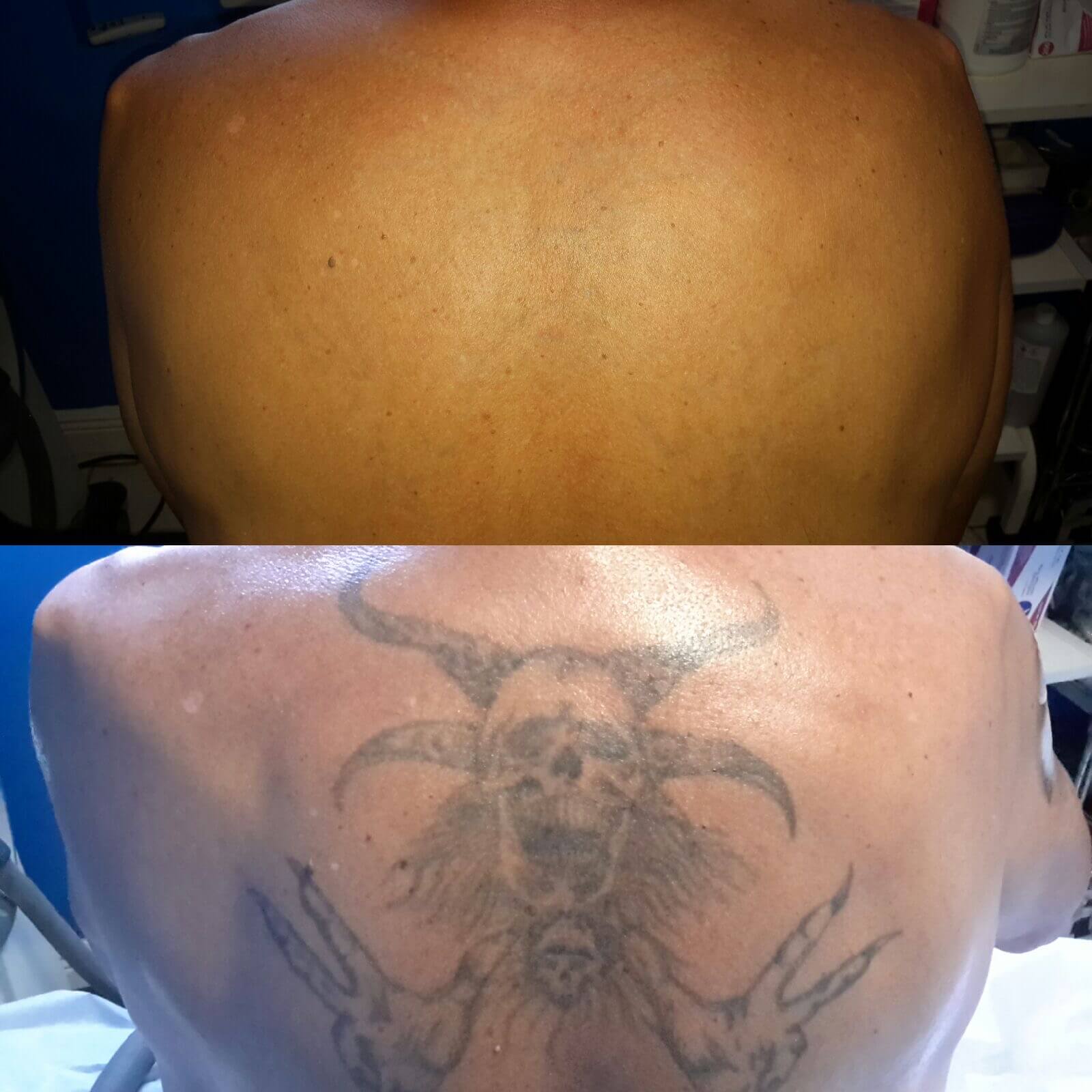 Has anyone wanted or had laser tattoo removal after a new tattoo, and how  long did you wait? Some people have told me 8 weeks and some have said 6  months. Does