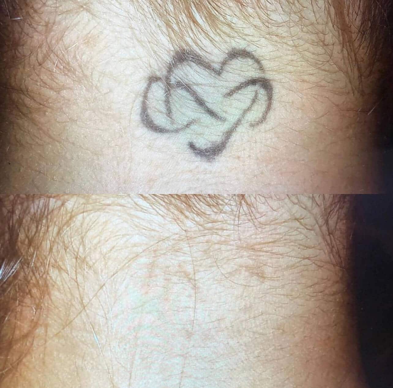 Laser tattoo removal Orlando