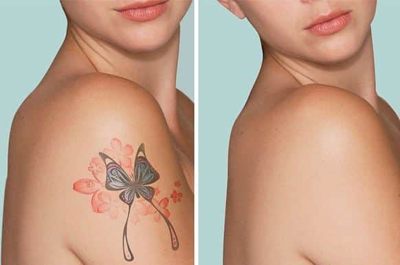 Laser tattoo removal Orlando