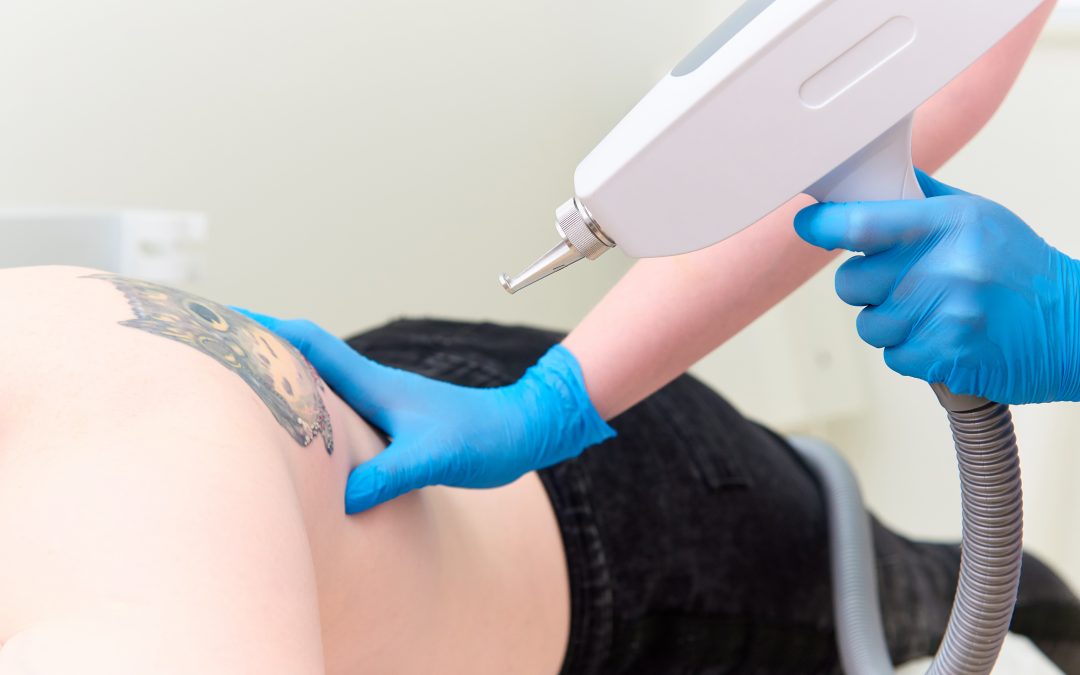 Why You Should Avoid Non Laser Tattoo Removal
