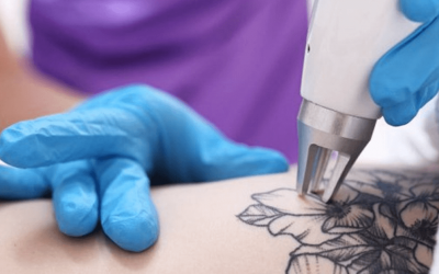 Skin Deep: The Journey of Uninking at Winter Park Tattoo Removal Center