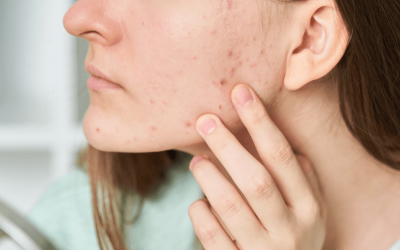 How Many Different Kinds of Skin Blemishes Are There?