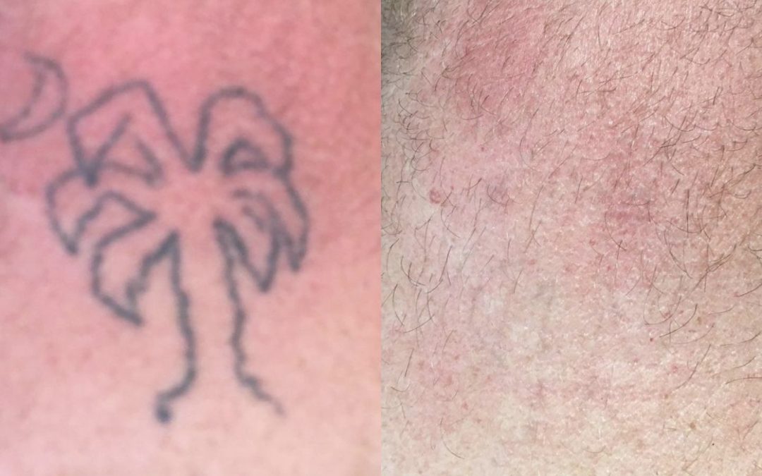Erase with Grace: Your Path to Renewed Skin with Laser Tattoo Removal