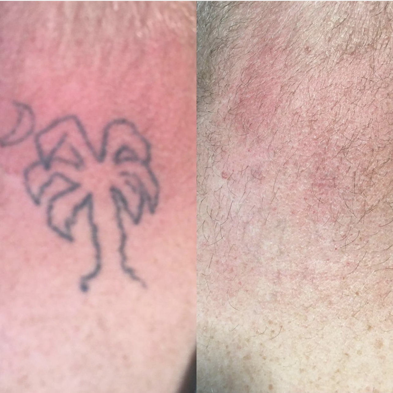 Laser Tattoo Removal | Sarasota, FL | Marlowe MD