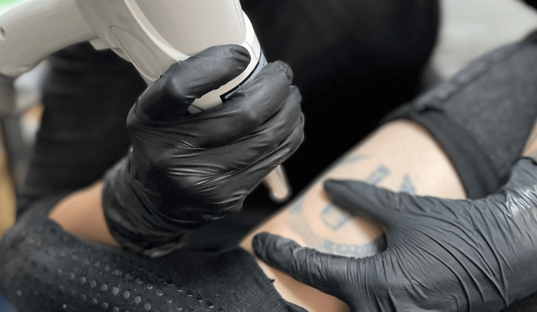 Laser Tattoo Removal FAQs: Everything You Need To Know