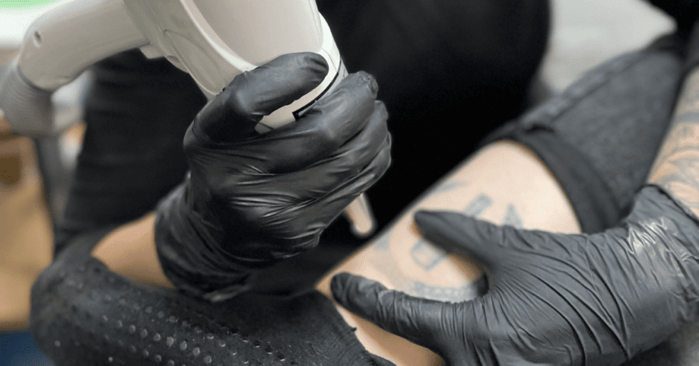Laser Tattoo Removal FAQs Winterpark Tattoo Removal