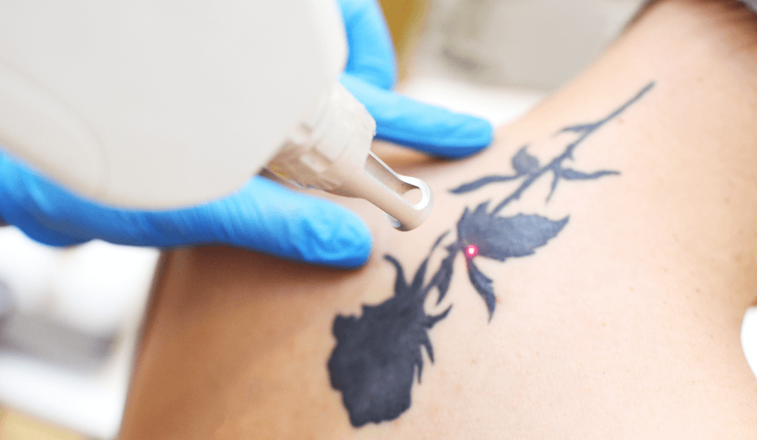Winter Park Tattoo Removal: Which Laser is Best for Tattoo Removal?
