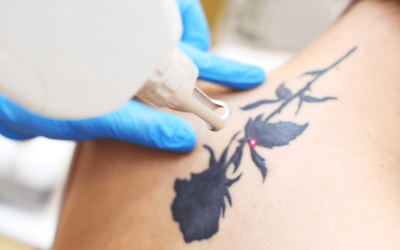 Erased Elegance: Redefining Your Canvas at Winter Park Tattoo Removal Clinic
