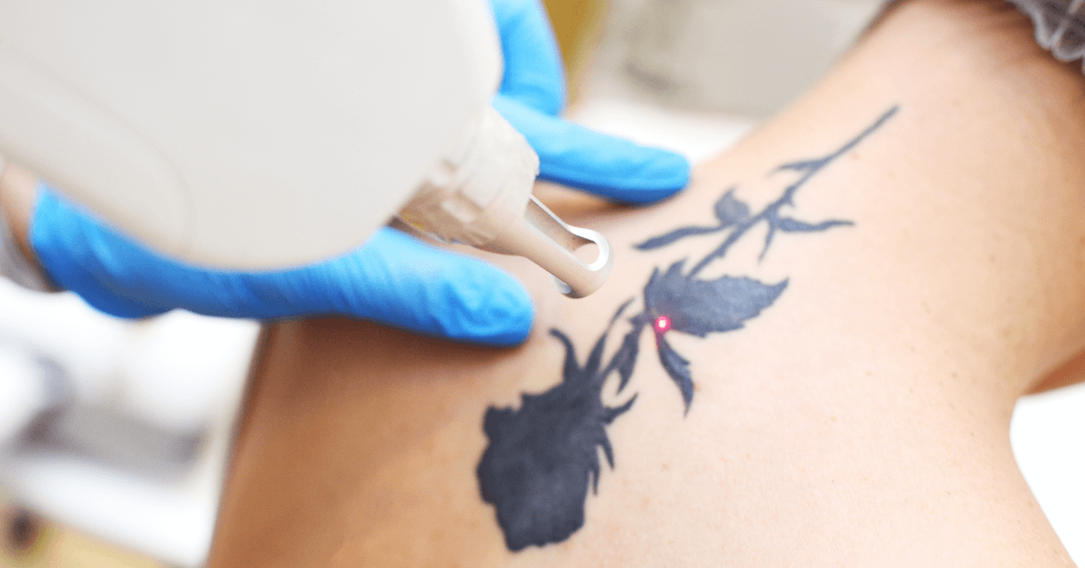 Best for Tattoo Removal
