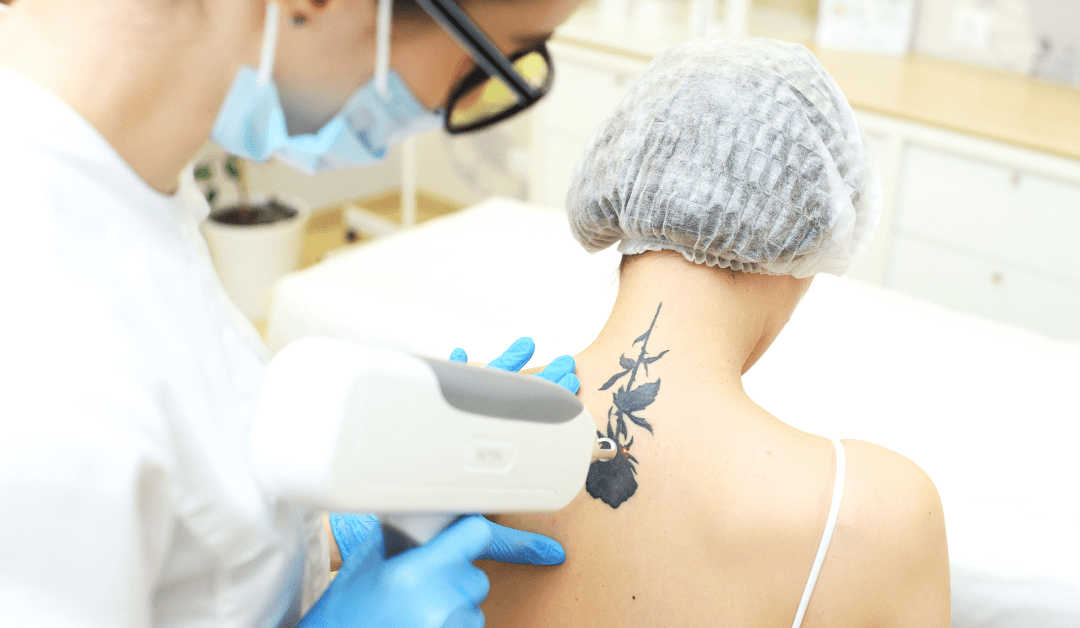 When is the Best Time to Get Laser Tattoo Removal?
