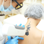 Laser Tattoo Removal