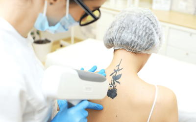 When is the Best Time to Get Laser Tattoo Removal?