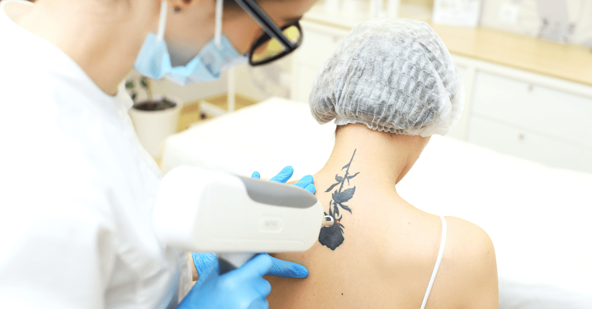 Laser Tattoo Removal