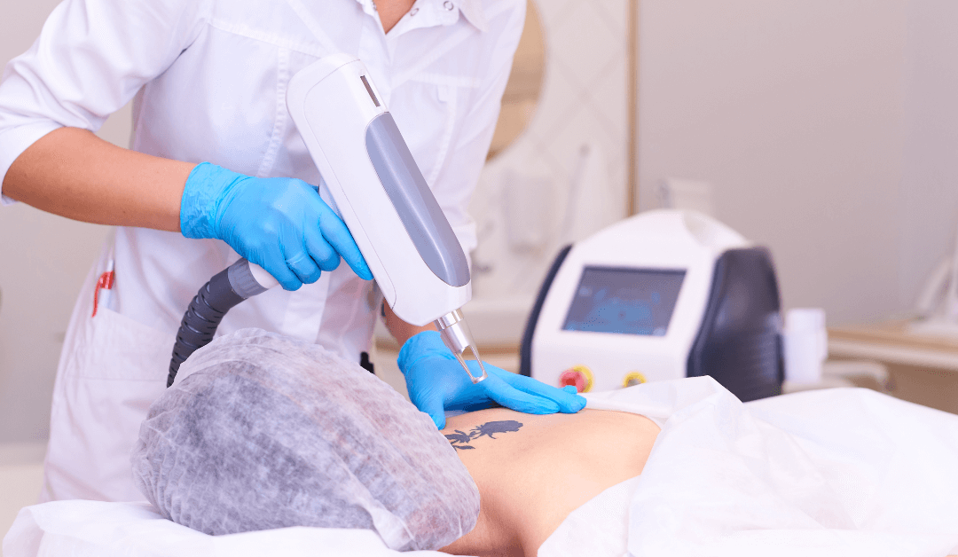 How to Prepare for Laser Tattoo Removal?