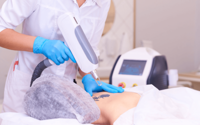 How to Prepare for Laser Tattoo Removal?