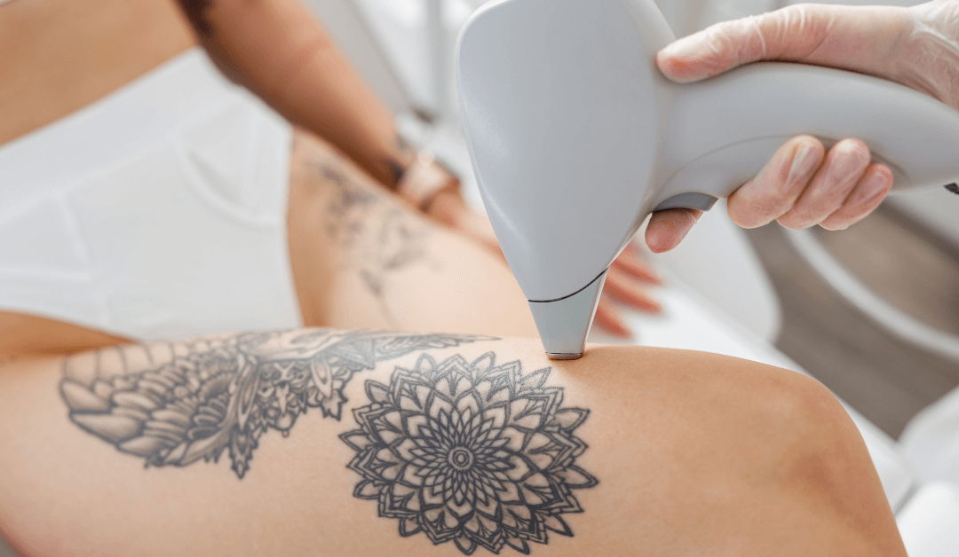 The Best Advanced Laser Tattoo Removal Technology in 2023
