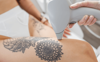 The Best Advanced Laser Tattoo Removal Technology in 2023
