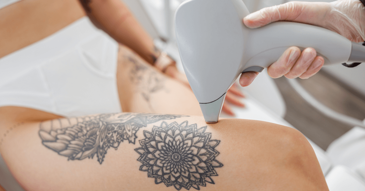 advanced laser tattoo removal | best tattoo removal orlando