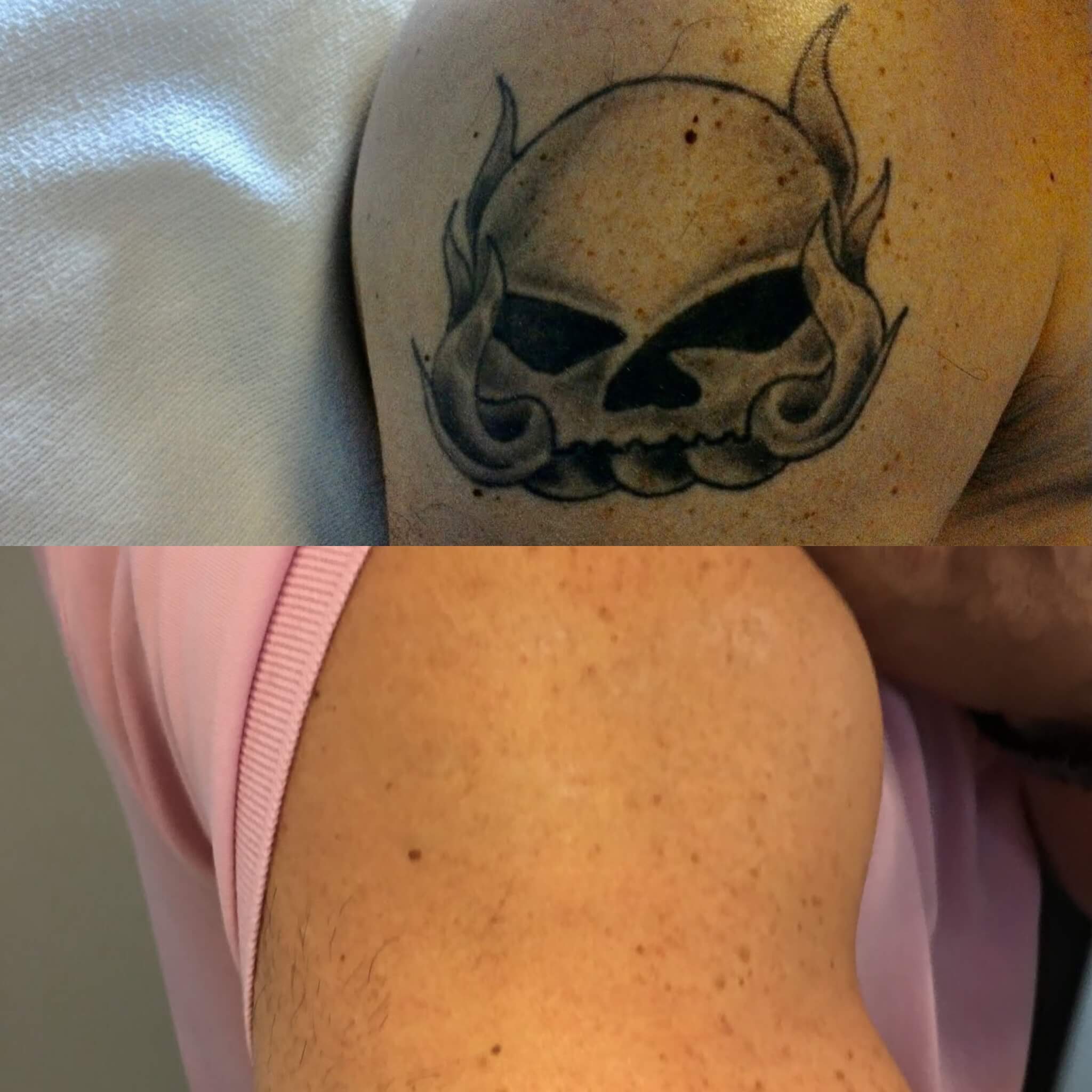 Winter Park tattoo removal clinic