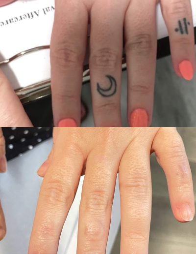 Tattoo removal in weeks not in years | Fingers Tattoo Removal Orlando