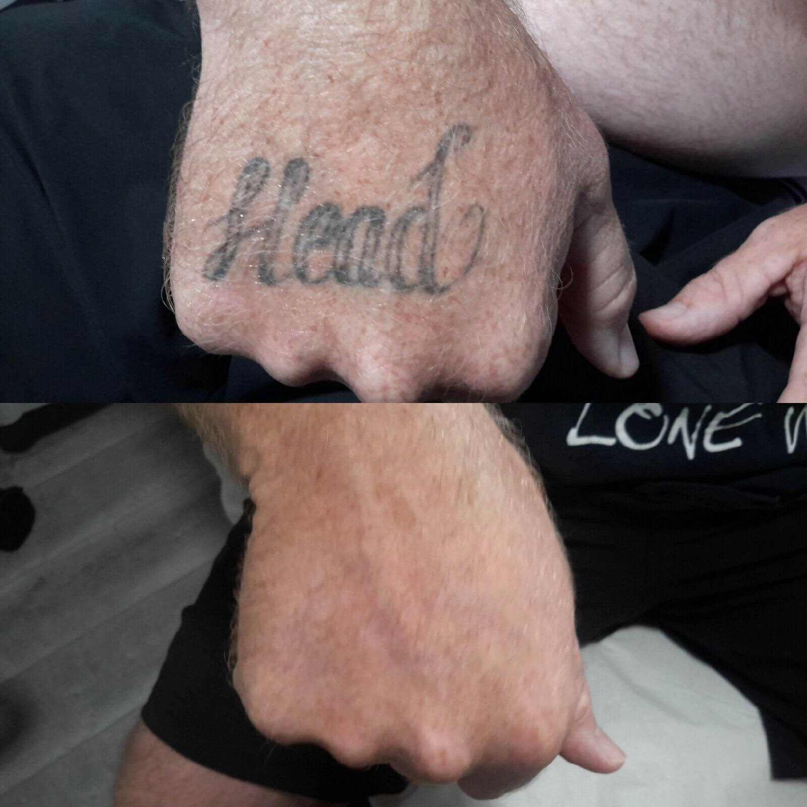 Hand's Tattoo removal services in winterpark | Winter park Tattoo Removal