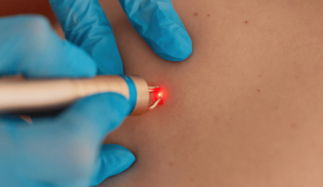 Unlocking Possibilities: Laser Tattoo Removal for Neck, Hand, and Color Tattoos at Winter Park Tattoo Removal