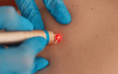 Unlocking Possibilities: Laser Tattoo Removal for Neck, Hand, and Color Tattoos at Winter Park Tattoo Removal