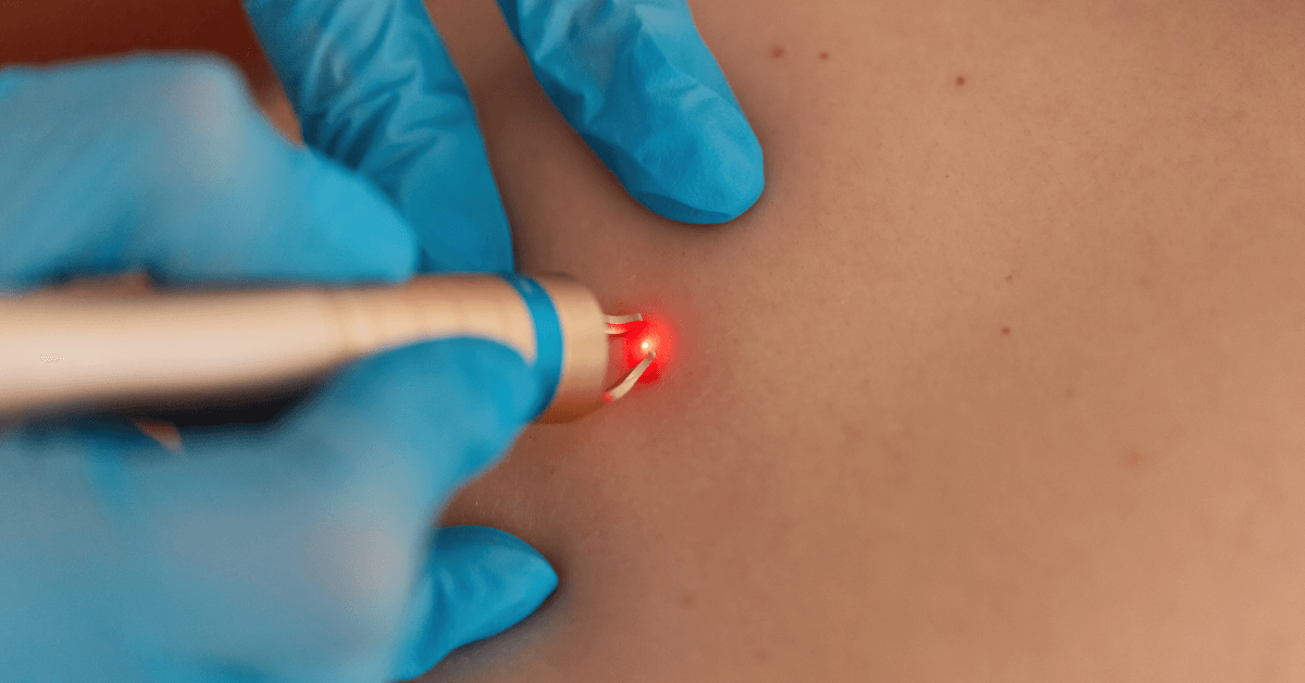 Tattoo Removal at Winter Park
