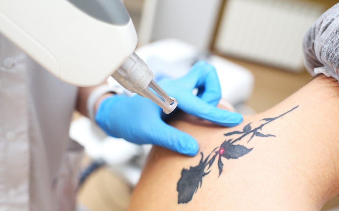 Preparing for Tattoo Removal: What to Expect and How to Get Ready