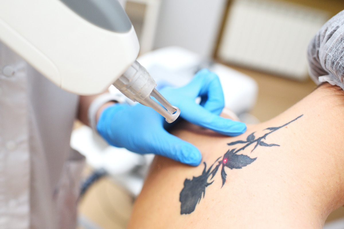 Laser Tattoo Removal | The Aesthetic Edit