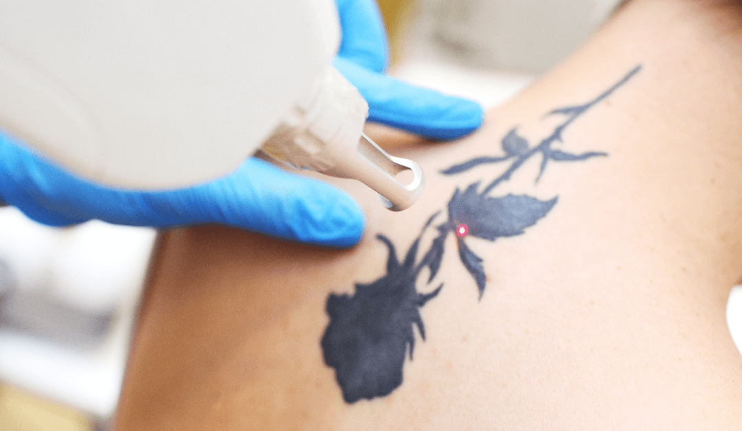 Starting Fresh: Your Journey with Laser Tattoo Removal