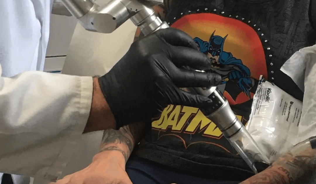 The Ultimate Guide to Large Tattoo Removal: Techniques, Timelines, and Transformations