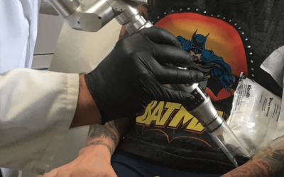 The Ultimate Guide to Large Tattoo Removal: Techniques, Timelines, and Transformations