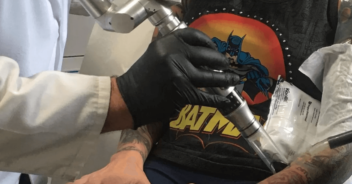 Large Tattoo Removal