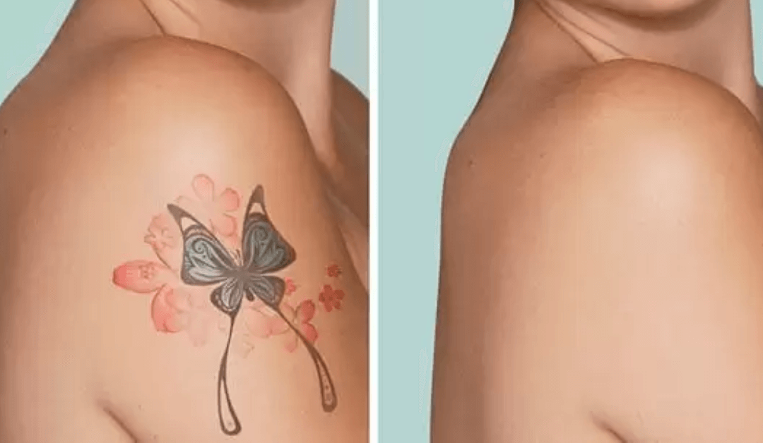 Before and After: Real Results at Winterpark Tattoo Removal