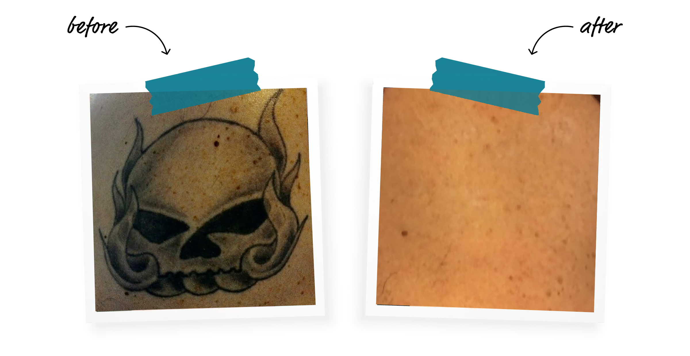 Winter Park tattoo removal clinic