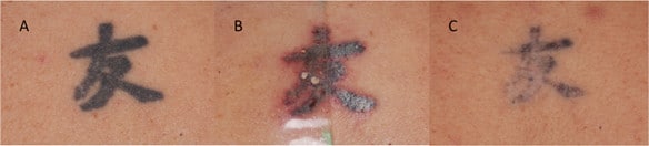 pfd patch laser removal