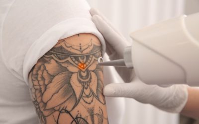 Does Art Tattoo Removal Hurt? Myths and Facts You Should Know