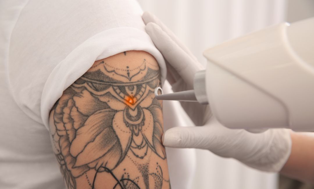 Does Art Tattoo Removal Hurt? Myths and Facts You Should Know