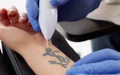 How Technology Has Advanced to Provide the Best Tattoo Removal Treatment?