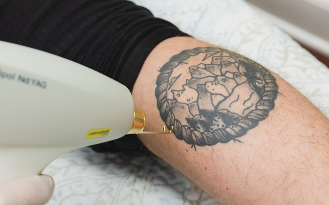 Exploring the Best Tattoo Removal Treatments and Alternative Tattoo Removal Options