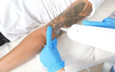 Best Tattoo Removal Options: Cream vs. Laser Removal Tattoo