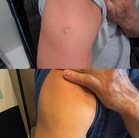 Tattoo removal Orlando