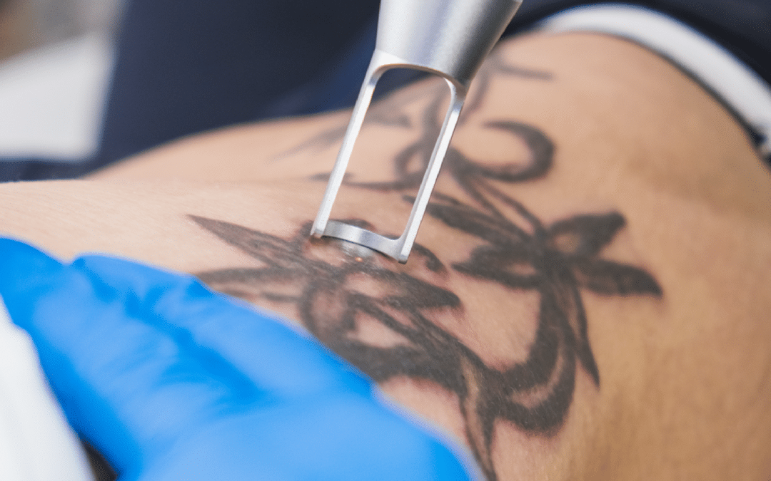Tattoo and Scar Solutions: Exploring Tattoo Removal Creams and Scar Removal Lasers