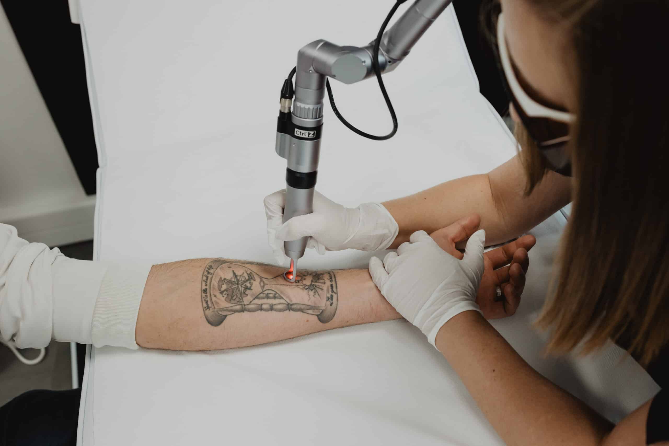 Art Tattoo Removal
