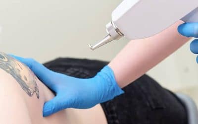 Advanced Laser Tattoo Removal in Winter Park
