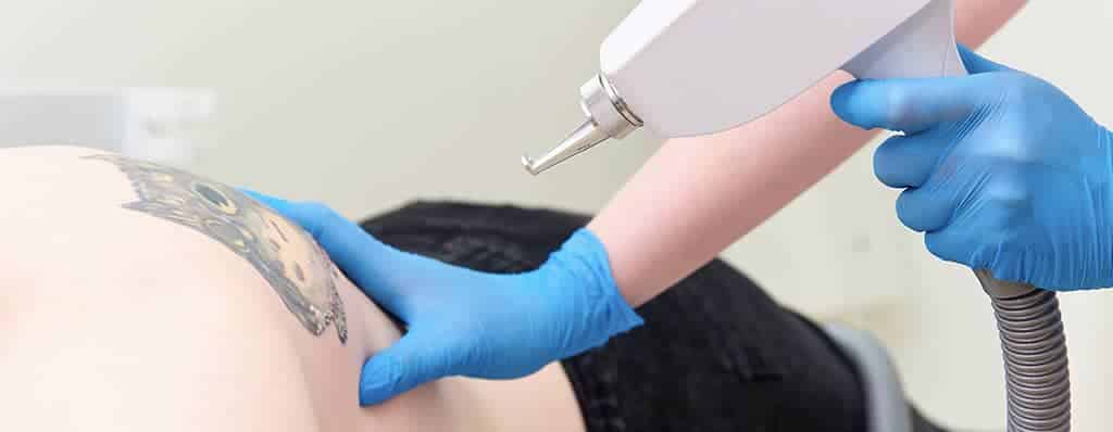 Advanced Laser Tattoo Removal in Winter Park
