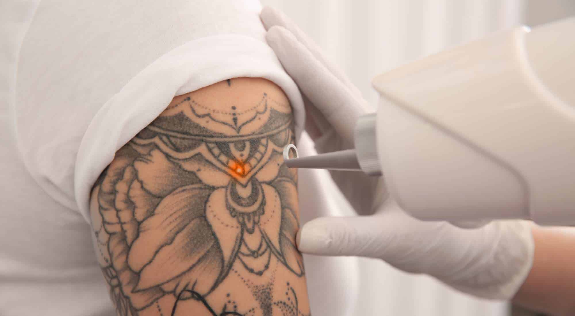 Art Tattoo Removal