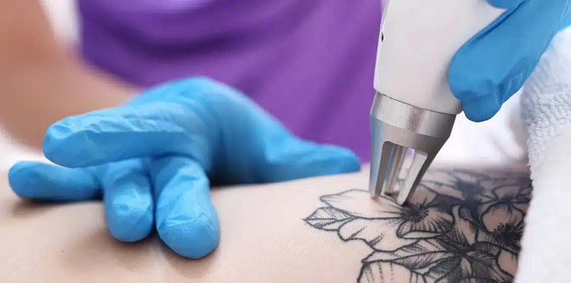 Advanced Laser Tattoo Removal