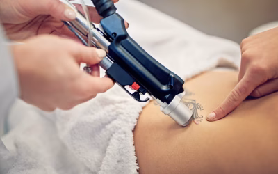Best Laser For Tattoo Removal